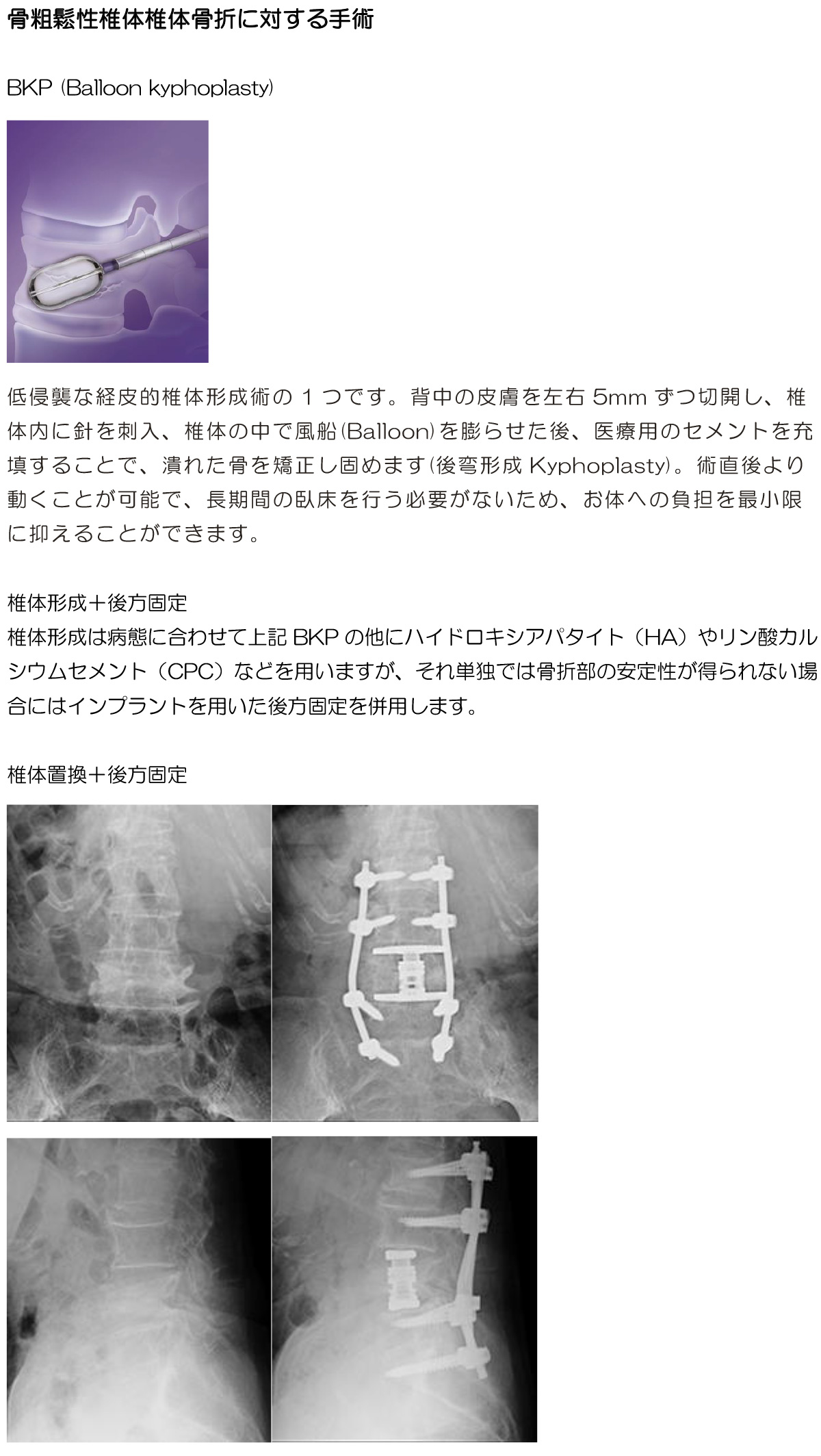 骨粗鬆性椎体椎体骨折に対する手術
